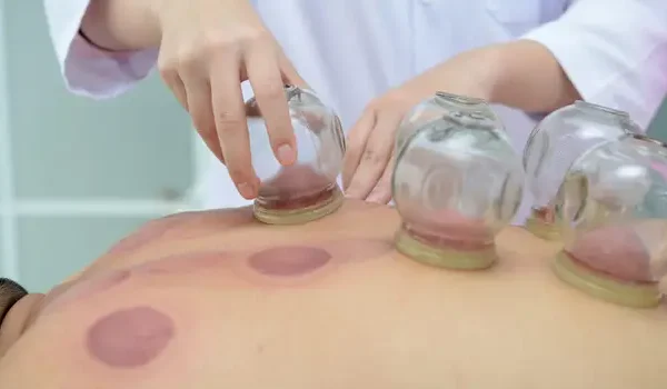 Cupping Therapy at Home | Cupping Physiotherapy At Home