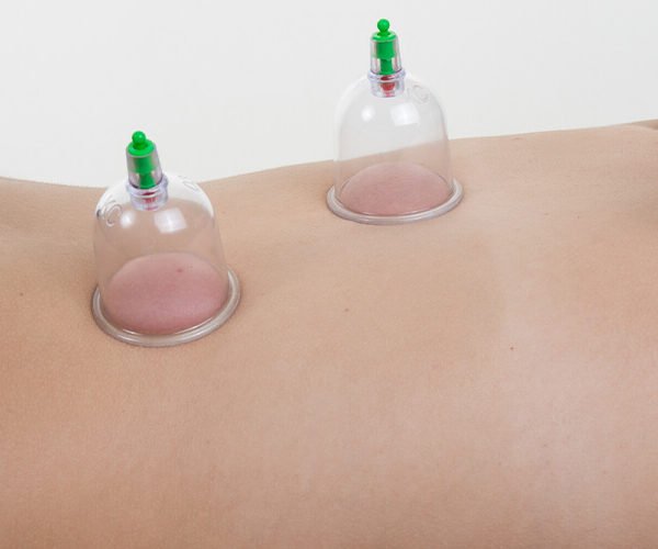 Cupping Therapy at Home | Cupping Physiotherapy At Home