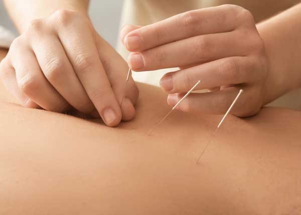 Dry Needling Physiotherapy at Home in Bangalore
